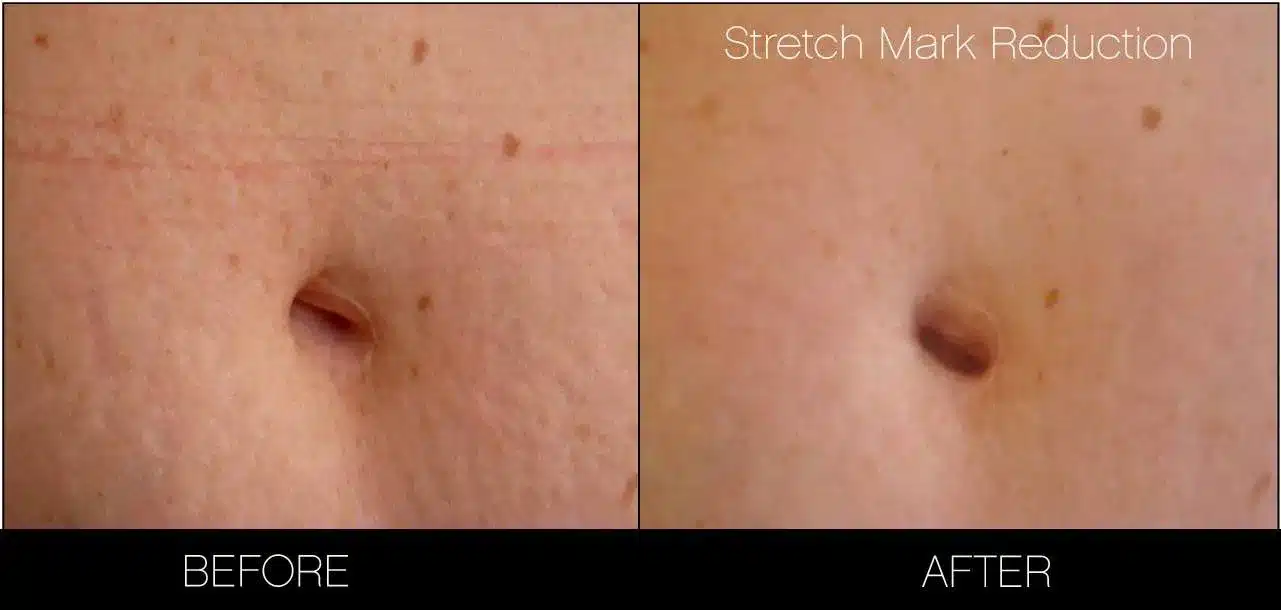 Inkless Stretch Marks Treatment Results Over Time 1 Inkless Skin Treatmens Stretch Mark Reduction - Skin Camouflage