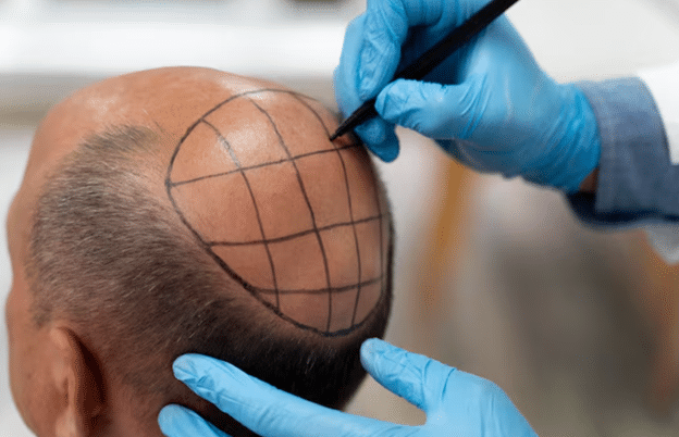Hair Tattoo (SMP) vs. Hair Transplant: Which Is Better?
