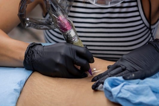 How Medical Tattooing Helps Hide Stretch Marks &Amp; Scars 1 Medical Tattooing For Stretch Marks