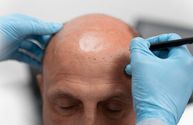 Scalp Micropigmentation Hair Tattoo
