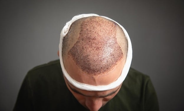 Scalp Micropigmentation