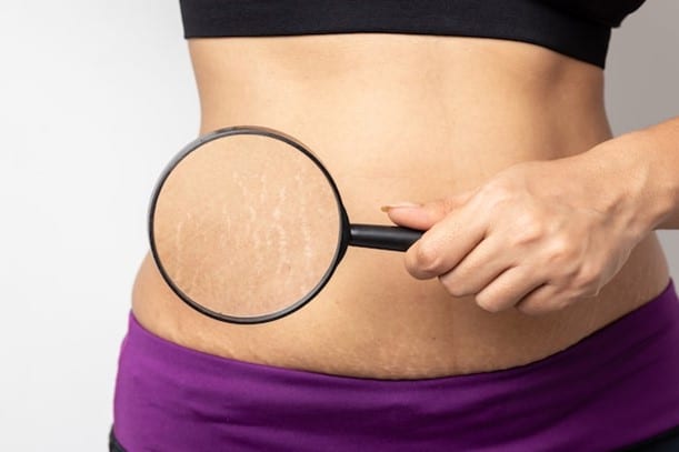 Stretch Mark Treatments