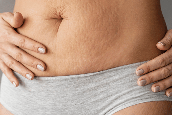 Stretch Mark Camouflage in Dubai: Who Gets the Best Results?
