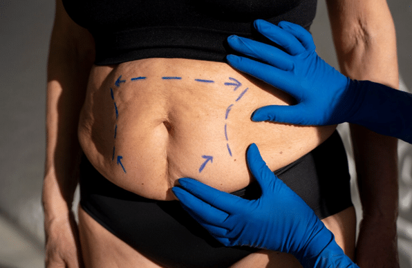 Stretch Mark Camouflage In Dubai: Who Gets The Best Results? 1 Stretch Mark Tattoo Camouflage Dubai