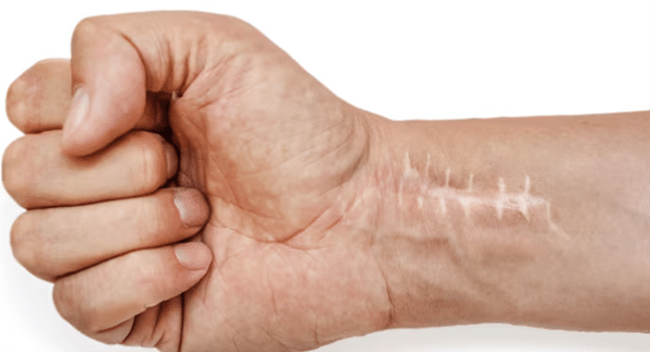 How To Choose The Best Scar Camouflage Clinic In Dubai 2 Safe Scar Camouflage In Dubai