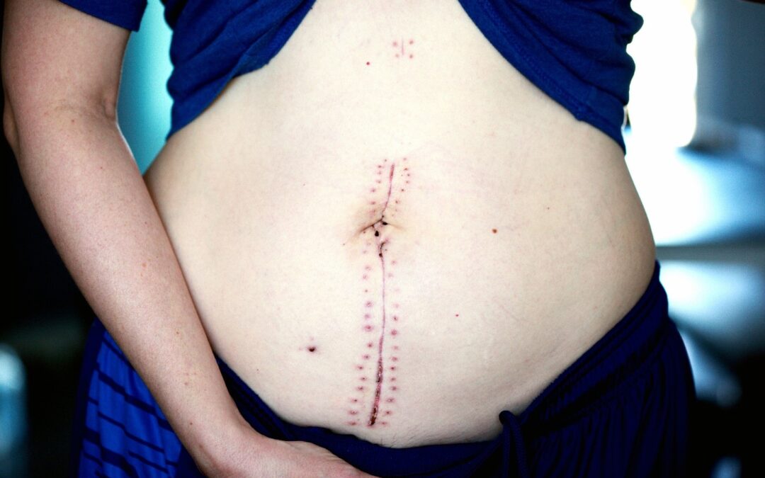 Non-Surgical Scar Removal Dubai: 5 Proven Treatments That Actually Work in 2026
