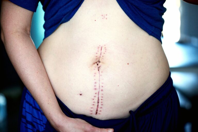 Scars Camouflage 39 Dubai Non-Surgical Scar Removal Care