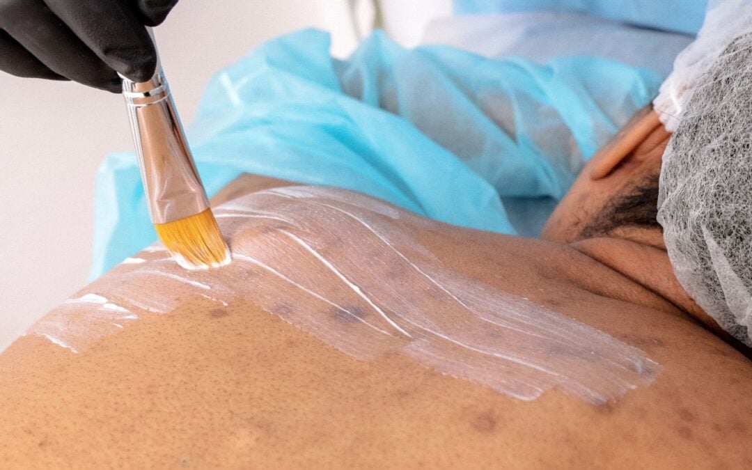 What Is Scar Camouflage Treatment? A Complete Guide for Dubai Residents