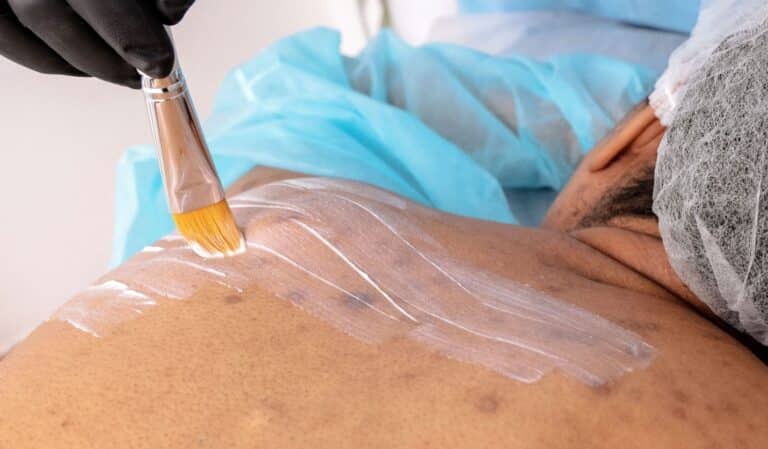 Scars Camouflage 38 Professional Scar Camouflage Treatment Dx