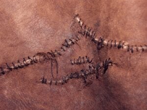 Scar Camouflage For Darker Skin Tones