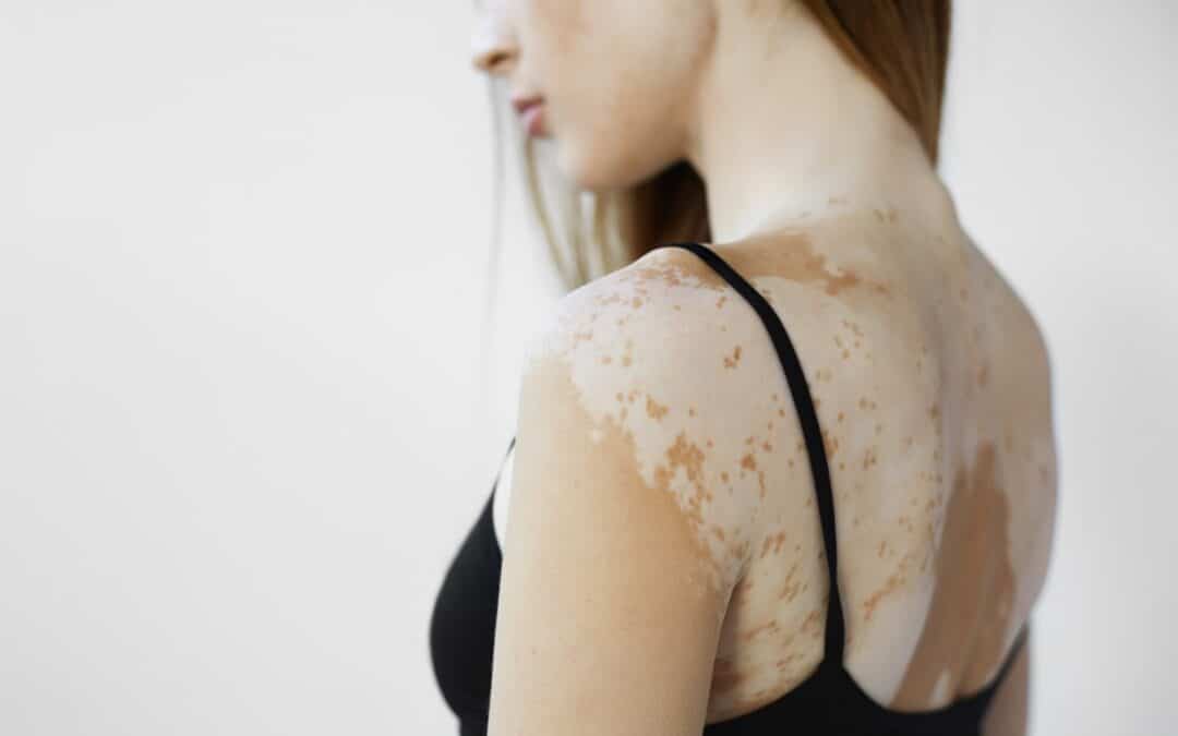 Vitiligo camouflage treatment Dubai