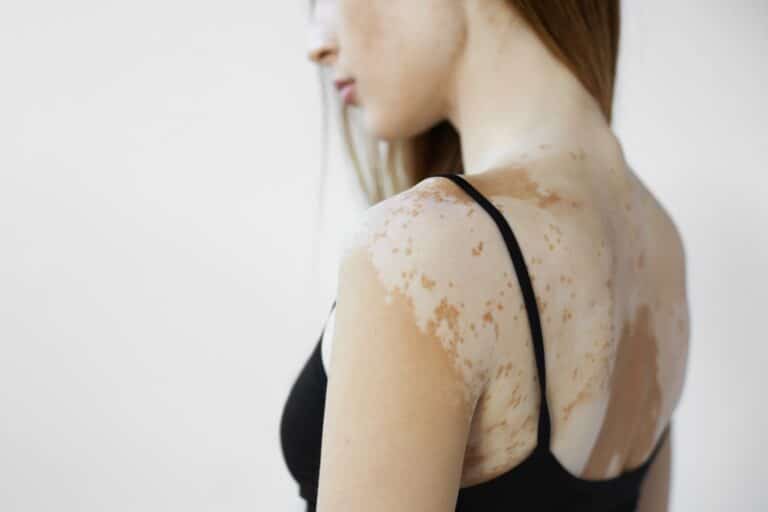 Scars Camouflage 35 Vitiligo Camouflage Treatment Dubai